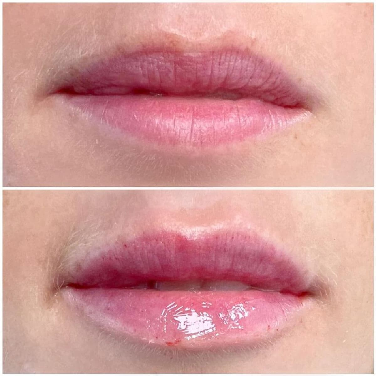 HIFU ultraheli lifting