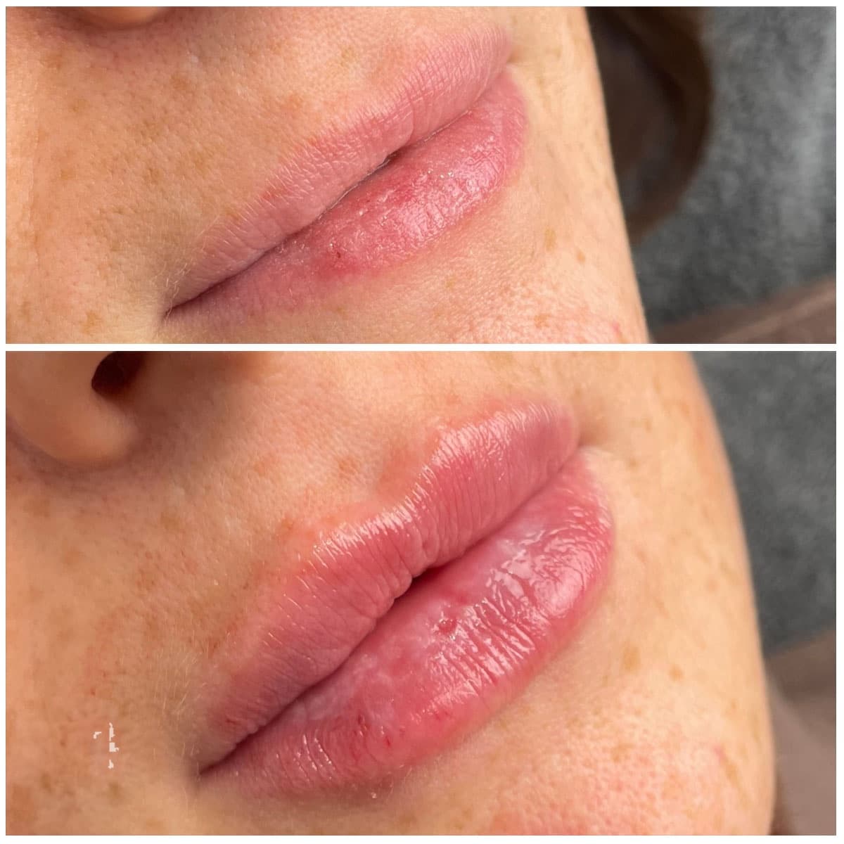 HIFU ultraheli lifting