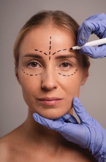 HIFU ultraheli lifting